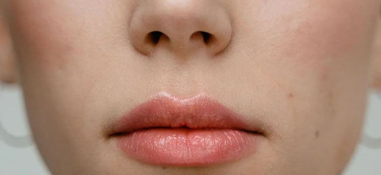 Herpes - die lästigen Lippenbläschen